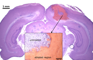 photo of a graphic brain scan showing the untreated regions of the brain, and the ablated region.
