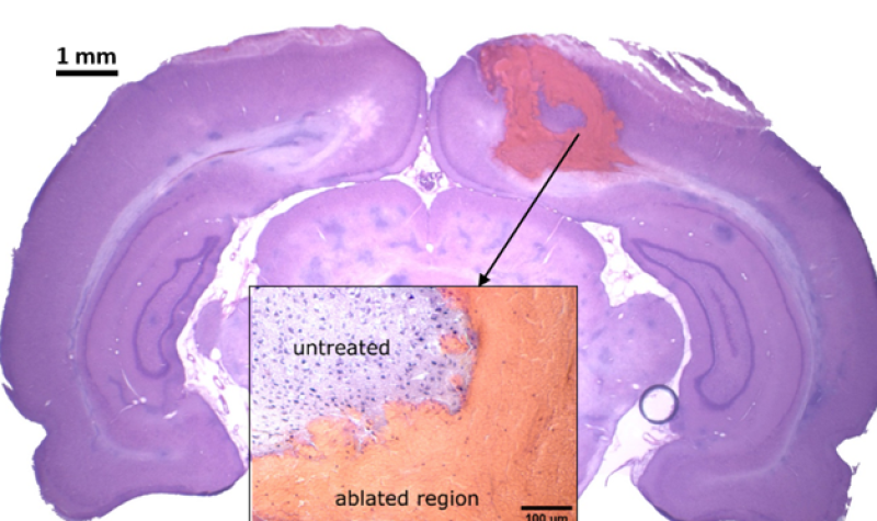 photo of a graphic brain scan showing the untreated regions of the brain, and the ablated region.